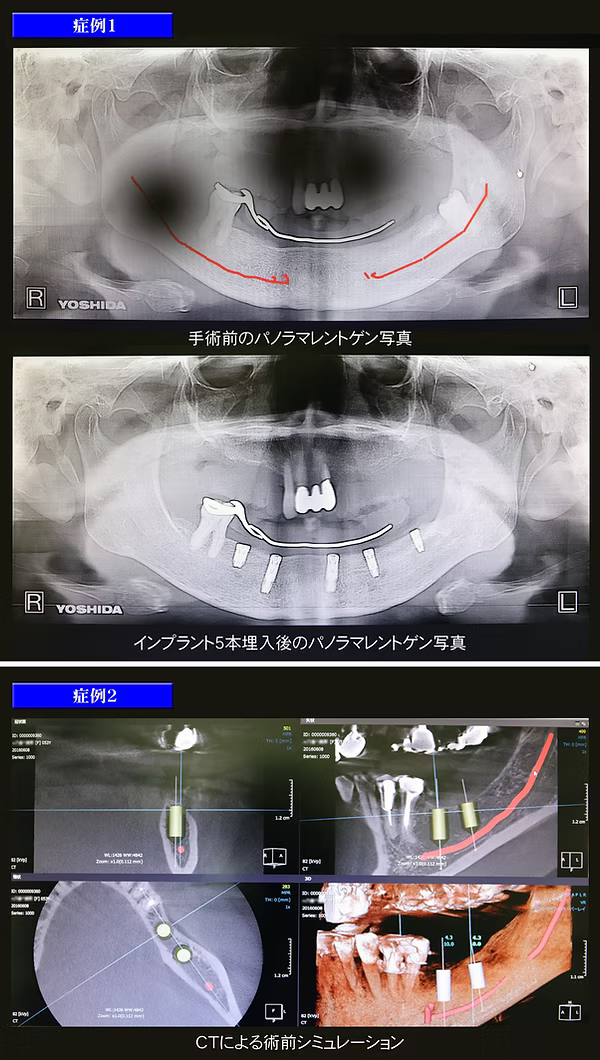 手術前後パノラマレントゲン
